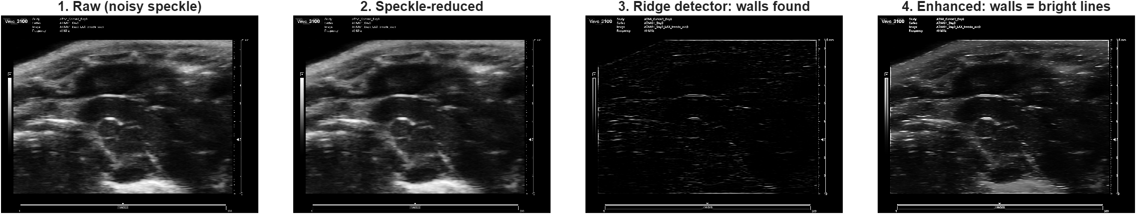 Four stages: raw, speckle-reduced, ridge detector, enhanced