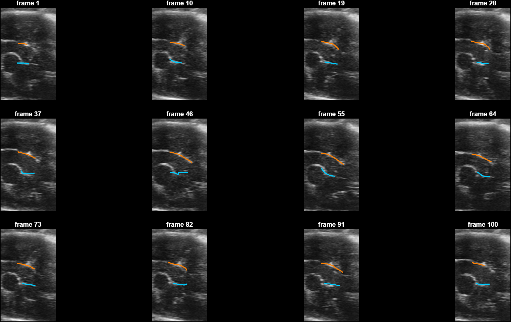 The detector's walls across frames